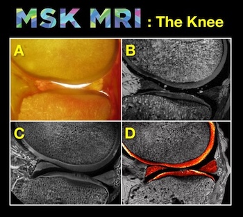 MRI knee