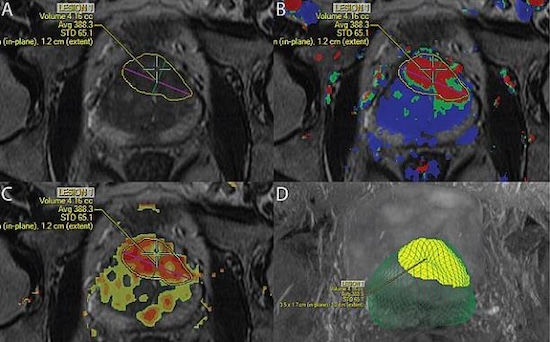 MRI prostate tumor