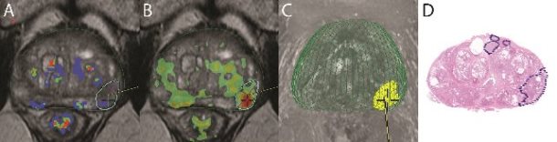 tumor biopsy